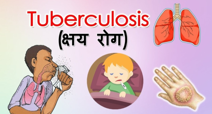 आज विश्व क्षयरोग दिवसः जनचेतनामूलक कार्यक्रम गरेर मनाइँदै